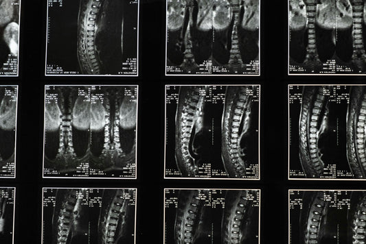 Comprehensive Guide to Herniated Disc Treatment and Therapy